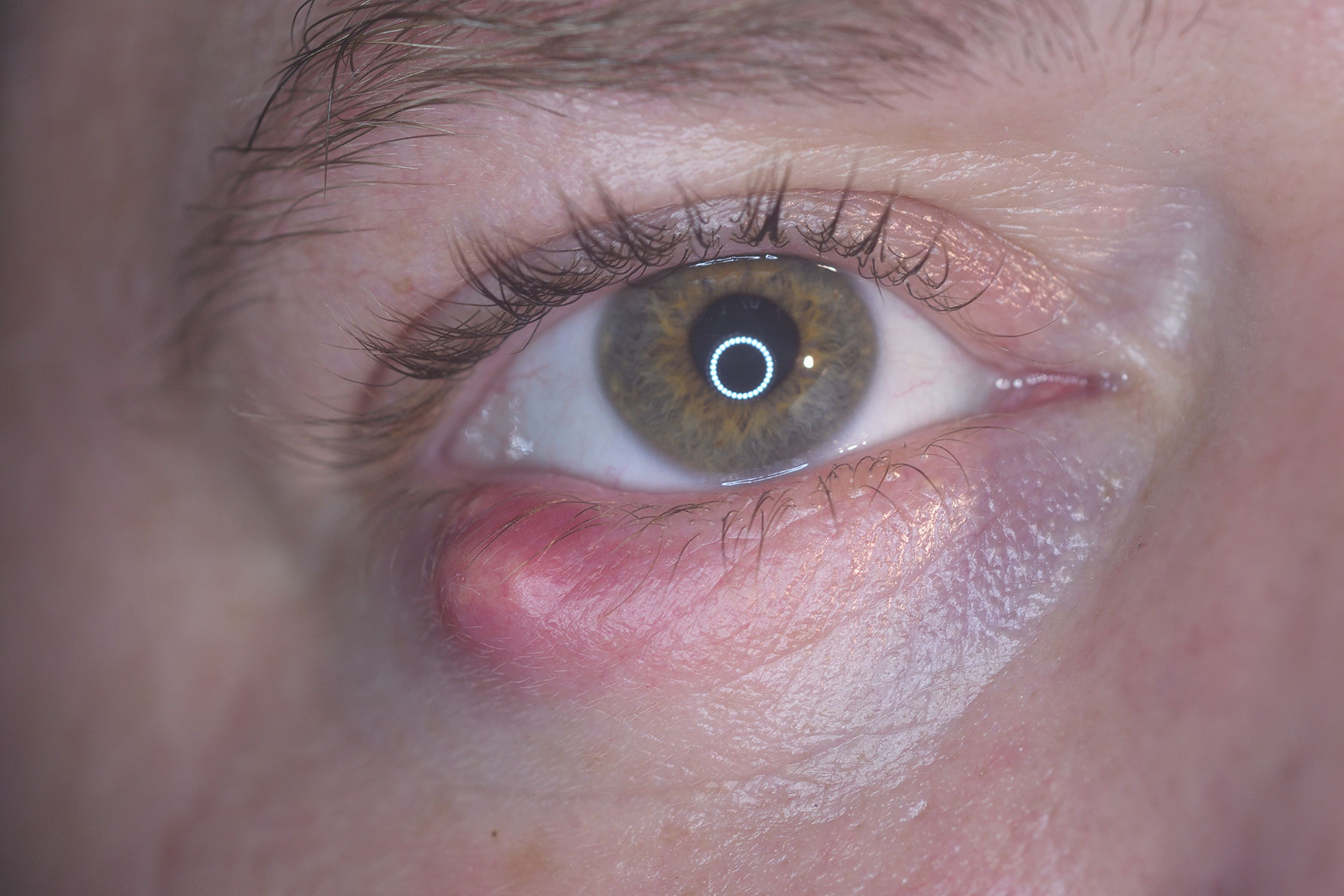 Chalazion eye condition