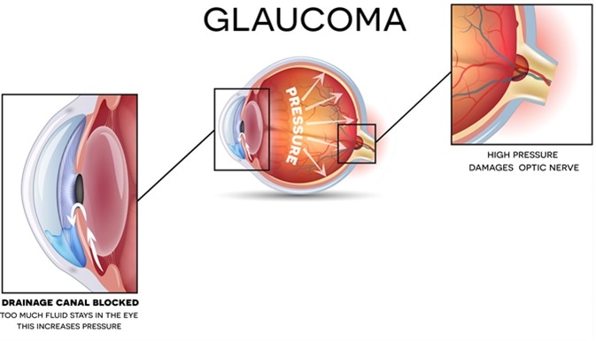 Glaucoma diagram